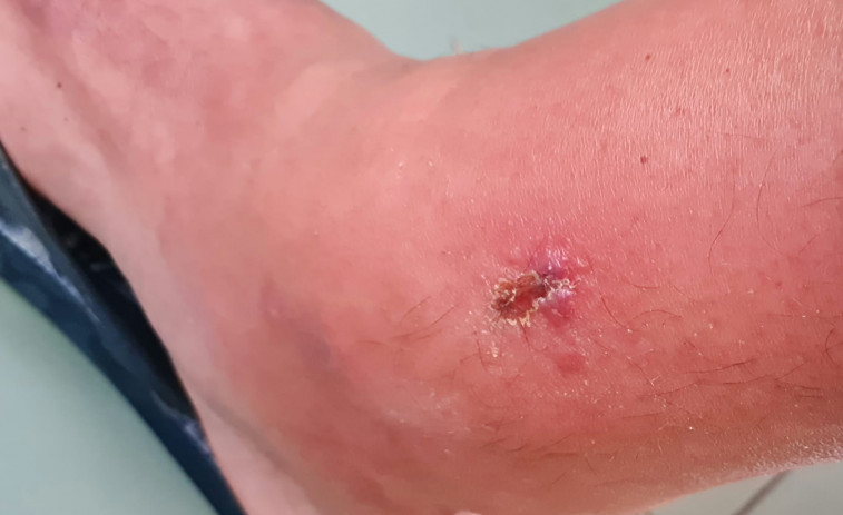 Acribillados por la desilusión... y por los mosquitos